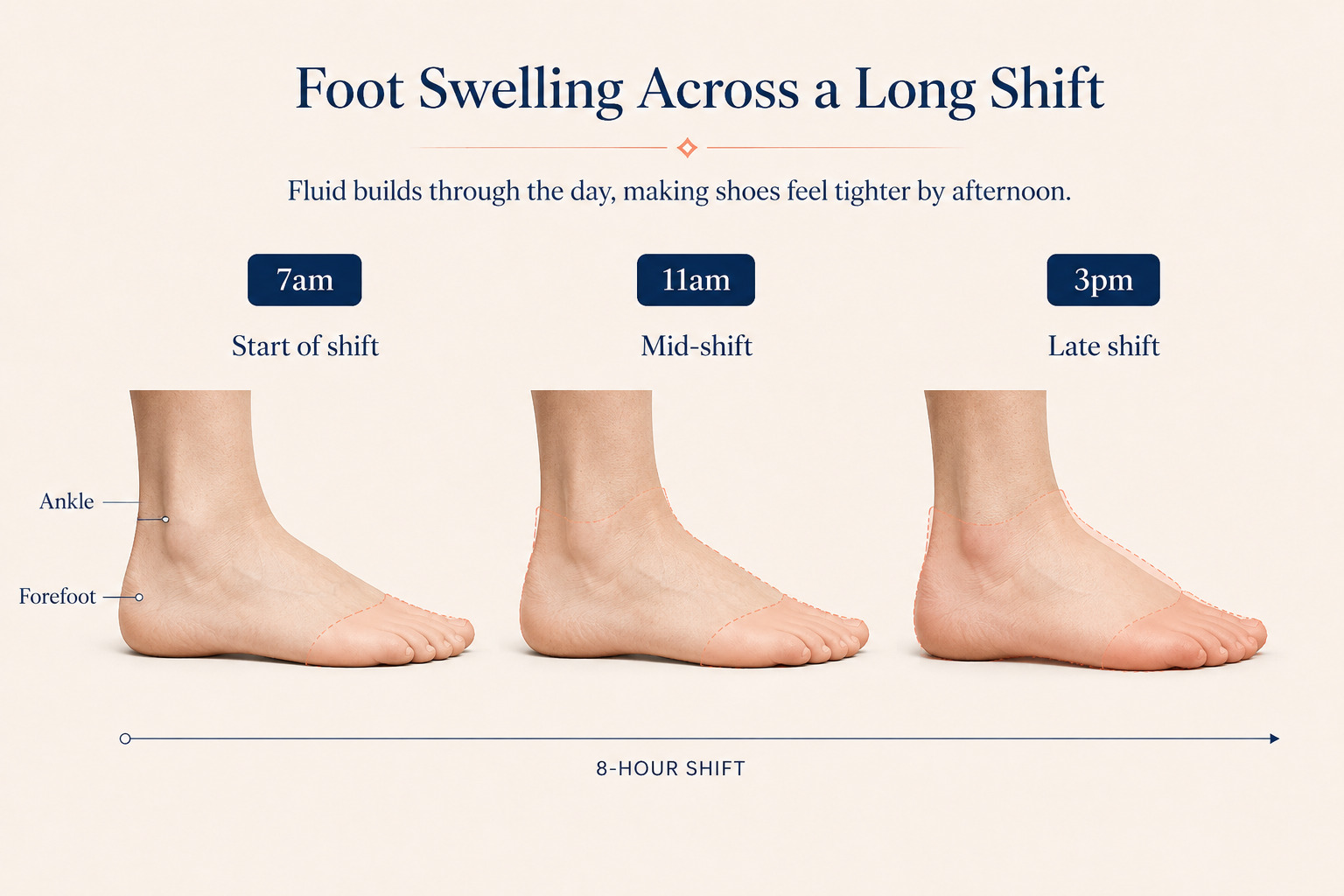 Diagram showing foot dimensional changes across an eight hour shift with increasing fluid accumulation in the forefoot and ankle regions